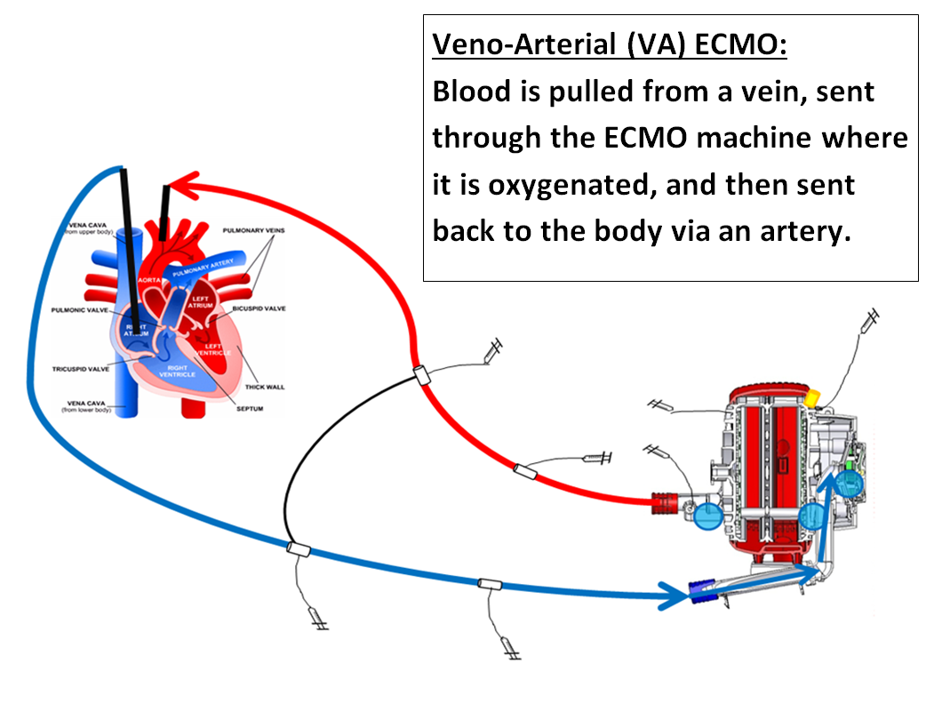 Diagram displaying VA ECMO. Blood is pulled from a vein, sent through the ECMO machine where it is oxgenated, and then sent back to the body via an artery.